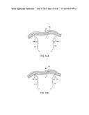 APPARATUS AND METHOD FOR INTRA-ABDOMINALLY MOVING A FIRST INTERNAL ORGAN     TO A POSITION AWAY FROM A SECOND INTERNAL ORGAN AND THEN HOLDING THE     FIRST INTERNAL ORGAN IN THE POSITION WITHOUT MANUAL INPUT diagram and image