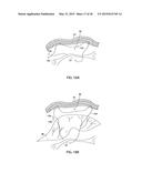 APPARATUS AND METHOD FOR INTRA-ABDOMINALLY MOVING A FIRST INTERNAL ORGAN     TO A POSITION AWAY FROM A SECOND INTERNAL ORGAN AND THEN HOLDING THE     FIRST INTERNAL ORGAN IN THE POSITION WITHOUT MANUAL INPUT diagram and image