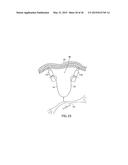 APPARATUS AND METHOD FOR INTRA-ABDOMINALLY MOVING A FIRST INTERNAL ORGAN     TO A POSITION AWAY FROM A SECOND INTERNAL ORGAN AND THEN HOLDING THE     FIRST INTERNAL ORGAN IN THE POSITION WITHOUT MANUAL INPUT diagram and image