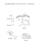 APPARATUS AND METHOD FOR INTRA-ABDOMINALLY MOVING A FIRST INTERNAL ORGAN     TO A POSITION AWAY FROM A SECOND INTERNAL ORGAN AND THEN HOLDING THE     FIRST INTERNAL ORGAN IN THE POSITION WITHOUT MANUAL INPUT diagram and image