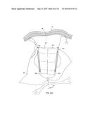 APPARATUS AND METHOD FOR INTRA-ABDOMINALLY MOVING A FIRST INTERNAL ORGAN     TO A POSITION AWAY FROM A SECOND INTERNAL ORGAN AND THEN HOLDING THE     FIRST INTERNAL ORGAN IN THE POSITION WITHOUT MANUAL INPUT diagram and image