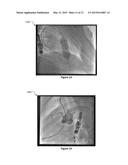 REAL-TIME IN VIVO MEASUREMENT OF THE 3D ANGULAR ORIENTATION OF     CARDIOVASCULAR STRUCTURES diagram and image