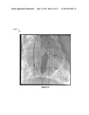 REAL-TIME IN VIVO MEASUREMENT OF THE 3D ANGULAR ORIENTATION OF     CARDIOVASCULAR STRUCTURES diagram and image