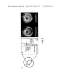 CATHETER DEVICE IMPLEMENTING HIGH FREQUENCY, CONTRAST IMAGING ULTRASOUND     TRANSDUCER, AND ASSOCIATED METHOD diagram and image