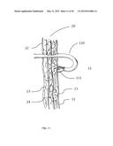 SYSTEM AND METHOD FOR EVALUATION OF THE PLEURAL SPACE diagram and image