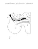 DEVICES AND METHODS FOR AIRWAY SUCTIONING diagram and image