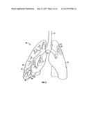 METHODS FOR TREATING A LUNG diagram and image