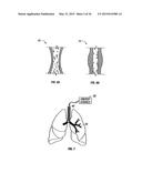 METHODS FOR TREATING A LUNG diagram and image