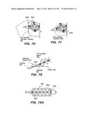 SYSTEMS AND METHODS FOR POSITIONING AN ELONGATE MEMBER INSIDE A BODY diagram and image