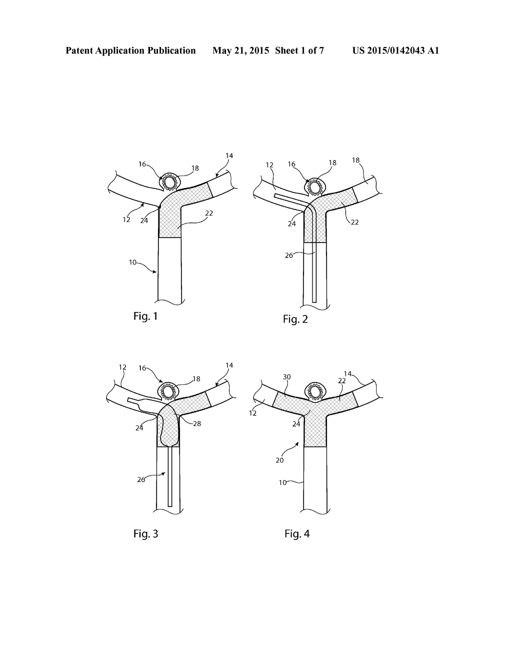 ANEURYSM CLOSURE DEVICE - diagram, schematic, and image 02