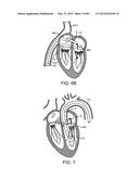 PROSTHETIC HEART VALVE DEVICES, PROSTHETIC MITRAL VALVES AND ASSOCIATED     SYSTEMS AND METHODS diagram and image