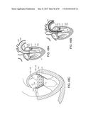 PROSTHETIC HEART VALVE DEVICES, PROSTHETIC MITRAL VALVES AND ASSOCIATED     SYSTEMS AND METHODS diagram and image