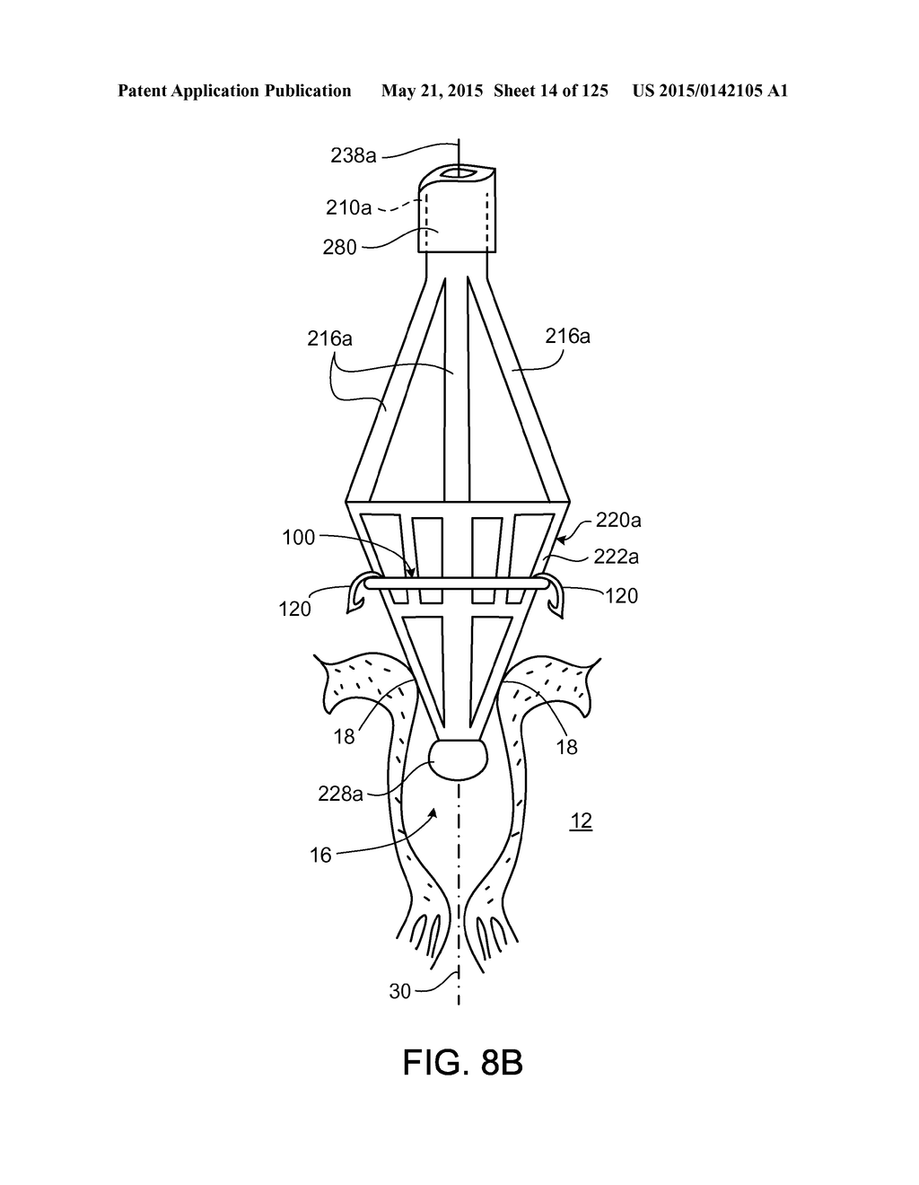 RECONFIGURING TISSUE FEATURES OF A HEART ANNULUS - diagram, schematic, and image 15