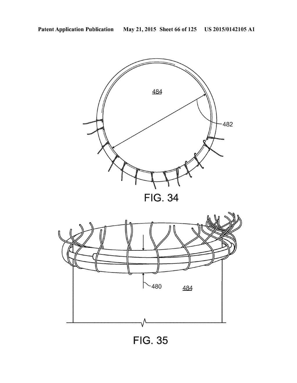 RECONFIGURING TISSUE FEATURES OF A HEART ANNULUS - diagram, schematic, and image 67