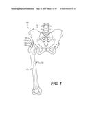 PROSTHETIC PLACEMENT TOOL AND ASSOCIATED METHODS diagram and image