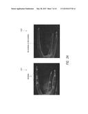 APPARATUS AND METHODS FOR FILLING TEETH AND ROOT CANALS diagram and image