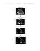 ULTRASONOGRAPHIC IMAGES PROCESSING diagram and image