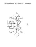 METHOD FOR FEMUR RESECTION ALIGNMENT APPROXIMATION IN HIP REPLACEMENT     PROCEDURES diagram and image