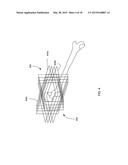 METHOD FOR FEMUR RESECTION ALIGNMENT APPROXIMATION IN HIP REPLACEMENT     PROCEDURES diagram and image