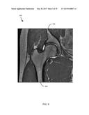 METHOD FOR FEMUR RESECTION ALIGNMENT APPROXIMATION IN HIP REPLACEMENT     PROCEDURES diagram and image