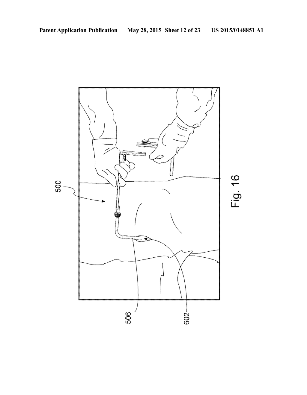 Devices, Systems, and Methods for Acetabulum Repair - diagram, schematic, and image 13