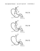 GASTRIC RETAINING DEVICES AND METHODS diagram and image