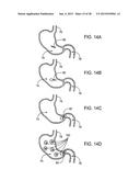 GASTRIC RETAINING DEVICES AND METHODS diagram and image