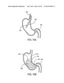 GASTRIC RETAINING DEVICES AND METHODS diagram and image