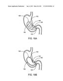 GASTRIC RETAINING DEVICES AND METHODS diagram and image