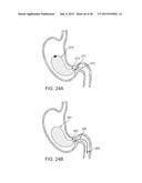 GASTRIC RETAINING DEVICES AND METHODS diagram and image