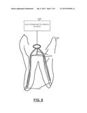 Pressure Wave Root Canal Cleaning System diagram and image