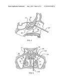 MULTI-CONDUIT BALLOON CATHETER diagram and image