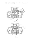 MULTI-CONDUIT BALLOON CATHETER diagram and image