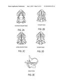 TREATMENT OF SPASMODIC DYSPHONIA VIA NEUROMODULATION diagram and image