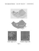 Method for Quantifying Immune Cells in Tumoral Tissues and its     Applications diagram and image