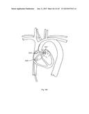 ROBOTIC CATHETER SYSTEM diagram and image
