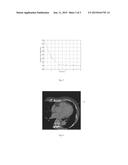 METHOD FOR IDENTIFYING CALCIFICATION PORTIONS IN DUAL ENERGY CT CONTRAST     AGENT ENHANCED SCANNING IMAGE diagram and image