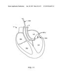 DELIVERY DEVICES AND METHODS FOR HEART VALVE REPAIR diagram and image