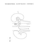 PROSTHETIC RENAL VALVE diagram and image