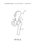 Retractor Tool For Minimally Invasive Hip Replacement Surgery diagram and image