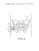 Retractor Tool For Minimally Invasive Hip Replacement Surgery diagram and image