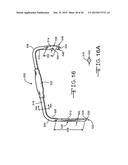 Retractor Tool For Minimally Invasive Hip Replacement Surgery diagram and image