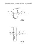 Vascular Occlusion diagram and image