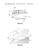 Catheter System diagram and image