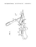 Fixation System, An Intramedullary Fixation Assembly and Method of Use diagram and image