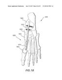 Fixation System, An Intramedullary Fixation Assembly and Method of Use diagram and image