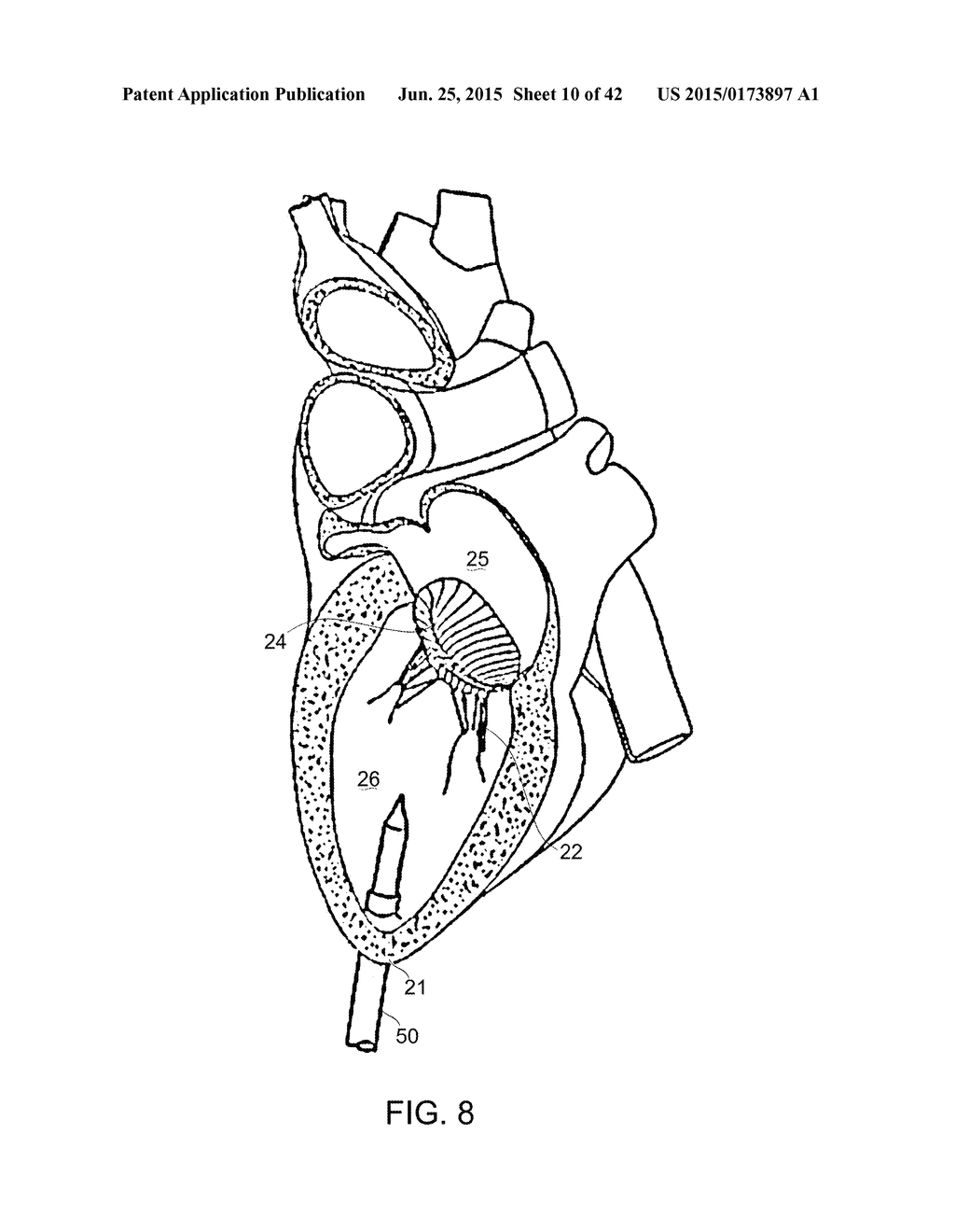 PROSTHETIC MITRAL VALVE - diagram, schematic, and image 11