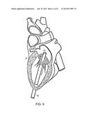 PROSTHETIC MITRAL VALVE diagram and image