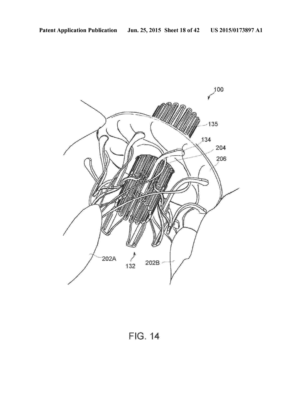 PROSTHETIC MITRAL VALVE - diagram, schematic, and image 19