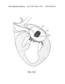 PROSTHETIC MITRAL VALVE diagram and image